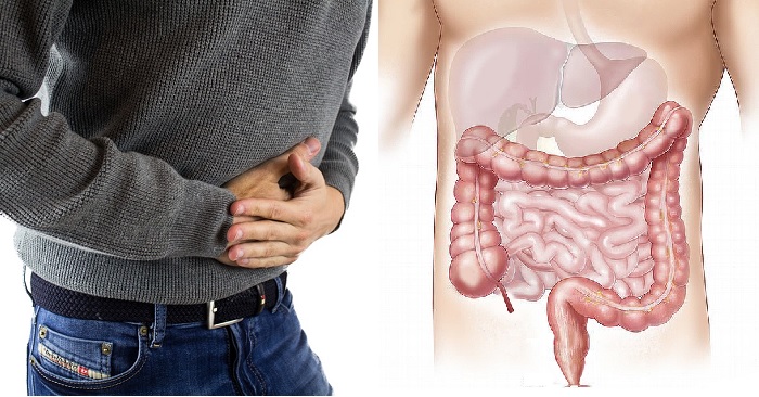 morbo di crohn