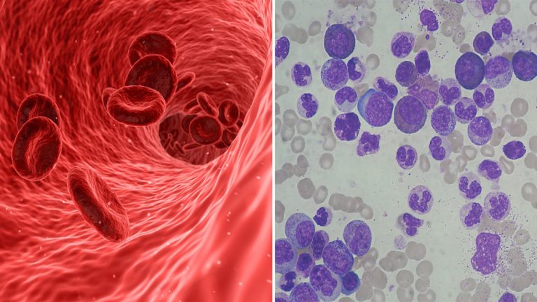leucemia