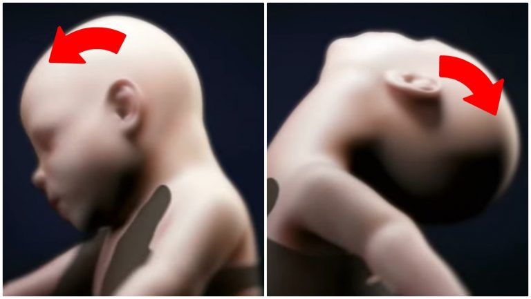 sindrome del bambino scosso